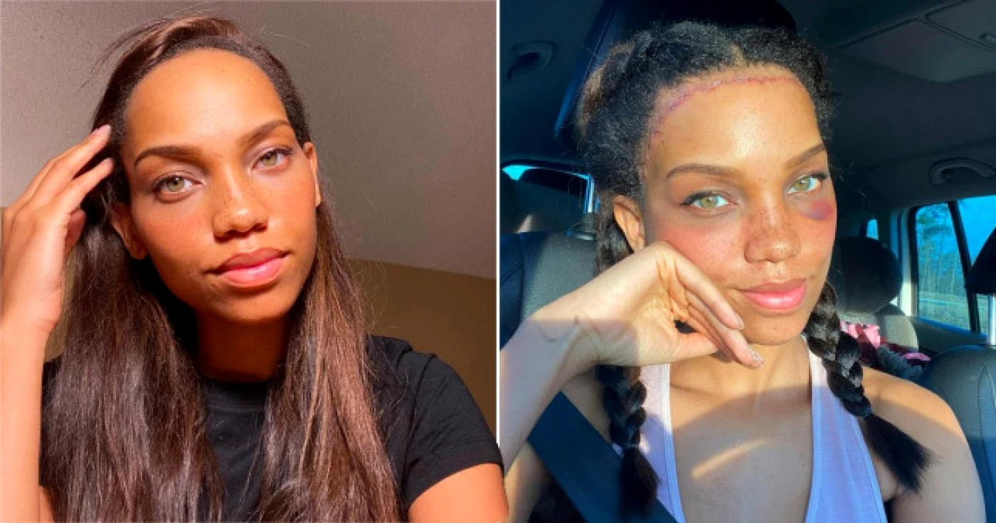 Camilla Brooks s-a simţit intotdeauna complexată de fruntea lată pe care o avea (Foto: Instagram).