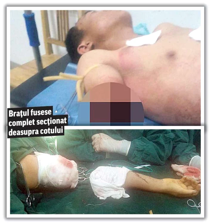 Chirurgii i-au montat nerv cu nerv membrul la loc chinezului Chen Tian, în vârstă de 21 de ani