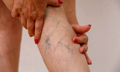 venectazii ACtive beat webp