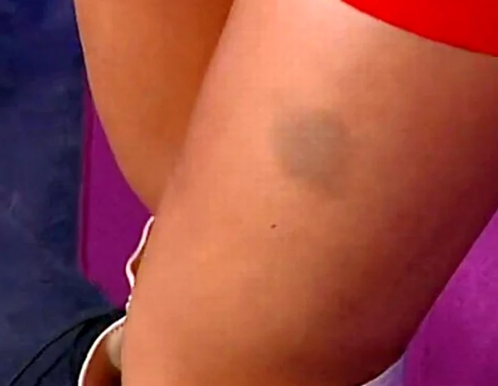 Elena a povestit cum s-a ales cu ditamai vânătaia