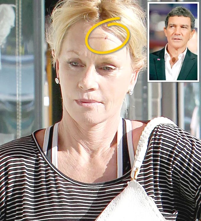 
    Melanie Griffith  avea o ditamai  vânătaia şi o tăietură  pe frunte  