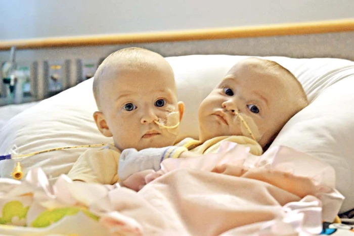 Miercuri, 7 noiembrie Siamezele aşteapă cu ochişorii mari să înceapă operaţia