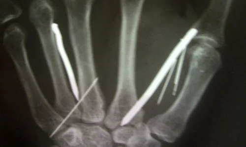 Femeia, în vârstă de 50 de ani, este tratată într un spital din Sri Lanka (Foto: Reuters) jpeg