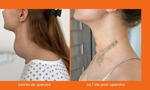 inainte si dupa operatie(1) jpeg