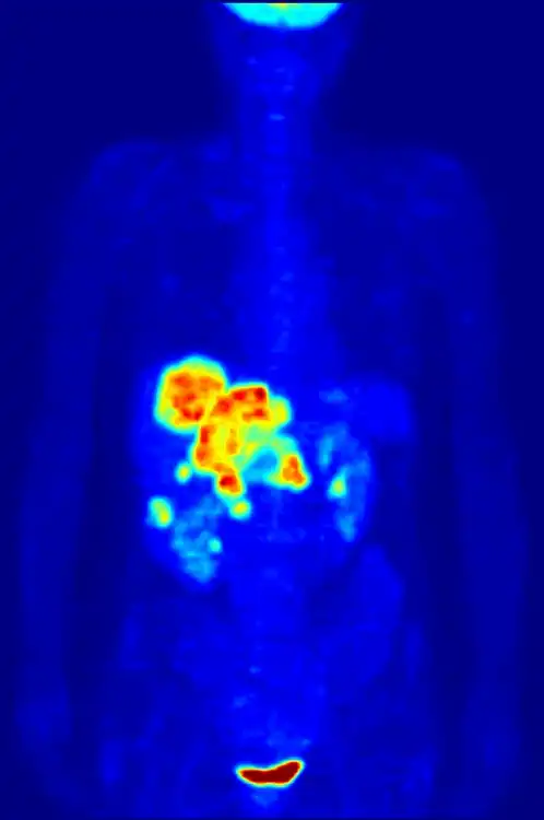 Tomografia care se roteşte