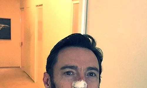Hugh Jackman a fost supus intervenției chirugicale de înlăturare a carcinomului în luna februarie, 2017 jpeg