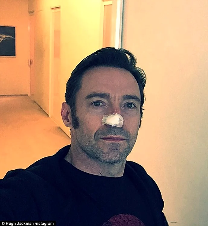 Hugh Jackman a fost supus intervenției chirugicale de înlăturare a carcinomului în luna februarie, 2017