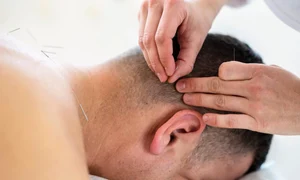 acupunctura jpg