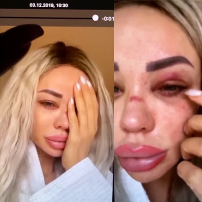 Bianca Drăgușanu a făcut publice mai multe imagini în care apare vânătă și umflată la fațăFoto: arhivă personală
