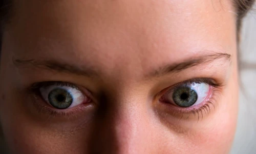 boala basedow graves jpg