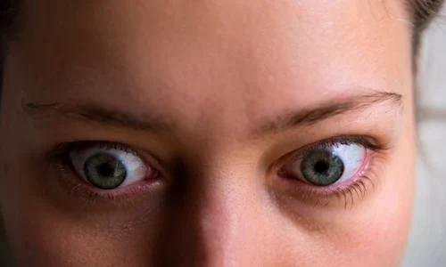 boala basedow graves jpg