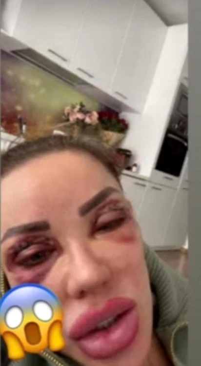 bianca dragusanu operatii pleoape vanata