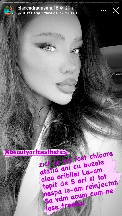 Bianca Drăgușanu, despre injectarea buzelor / Foto: Instagram