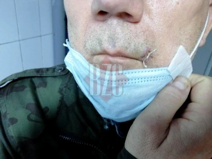 Vasile se plânge că a fost înjunghiat în buză de un vecin pe care îl deranjează sforăitul săuFoto: bzc.ro