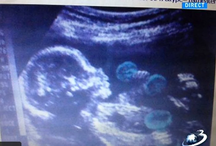 Copilul lui Mircea Badea se antrenează cu gantere în burtica mamei (Captură Antena 3)