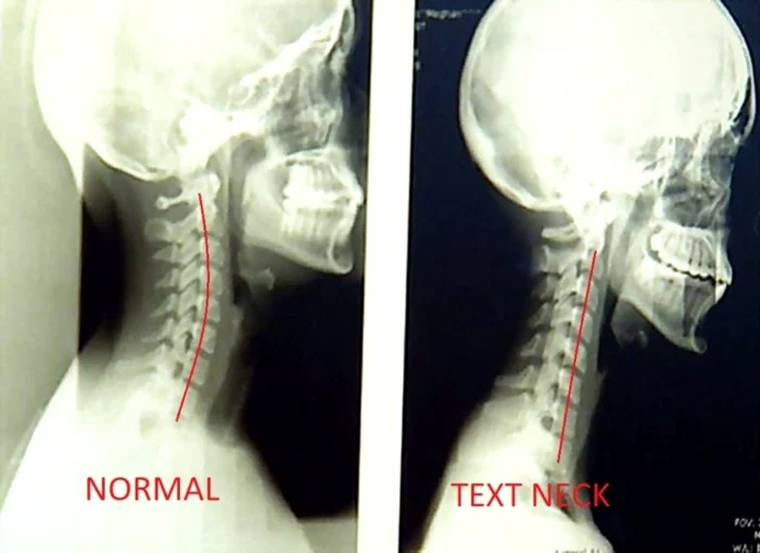 coloana cervicala sursa foto razvan darea