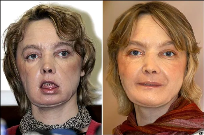 
    Prima pacientă care a beneficiat de un transplant de față, în Franța, în 2005  