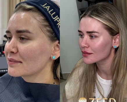Alesia Mitriță, înainte și după intervenția estetică Sursa/Zeedestethics