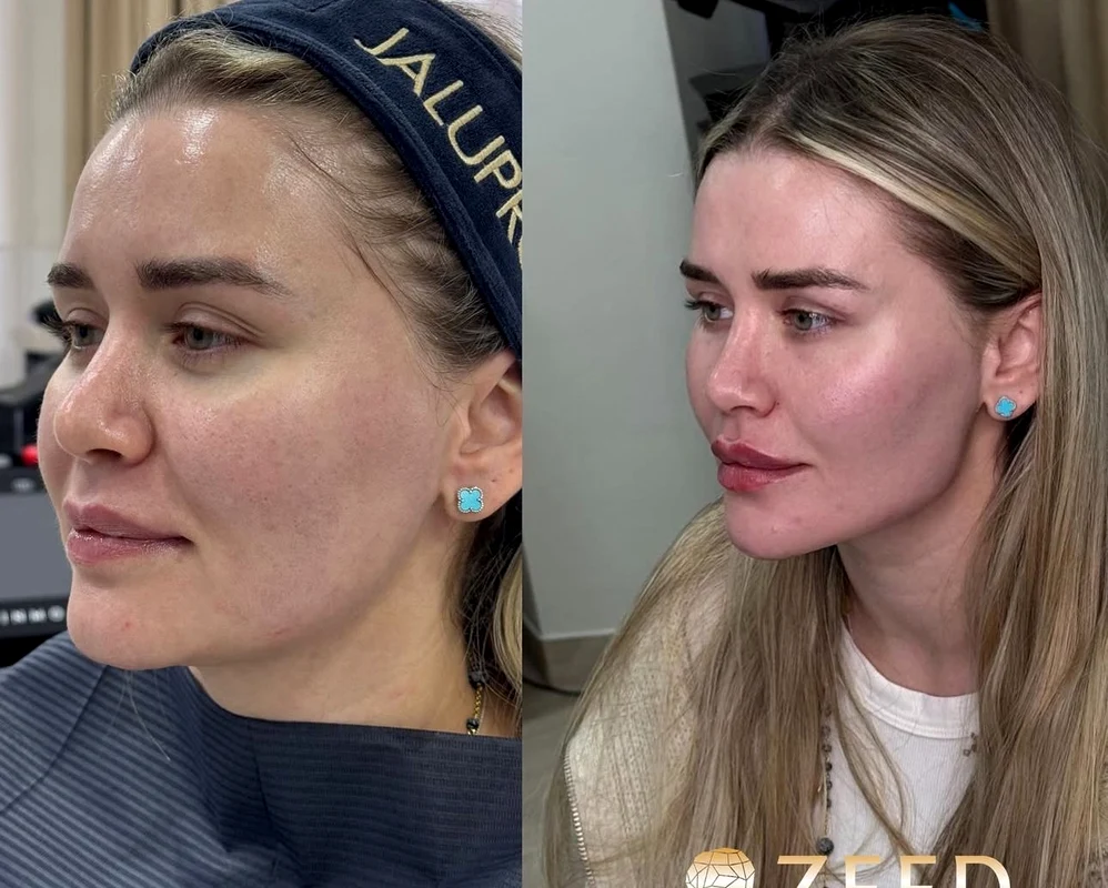 Alesia Mitriță, înainte și după intervenția estetică  Sursa/Zeedestethics
