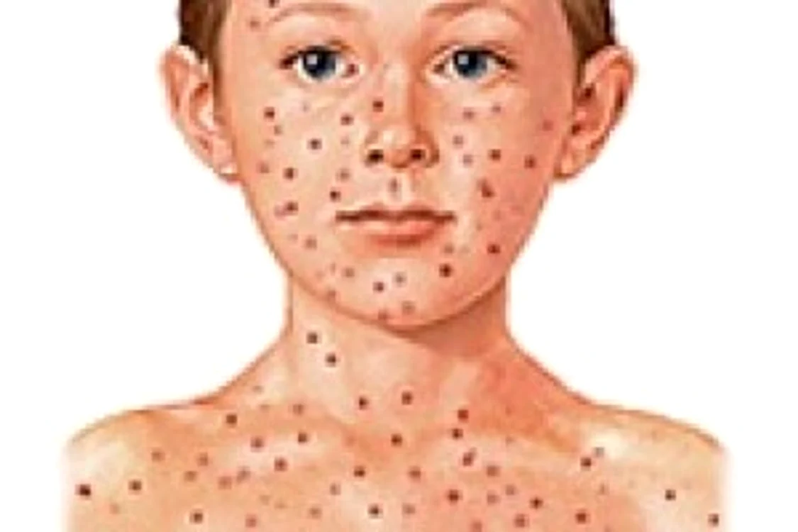 
    Varicela este o boală contagioasă și este una dintre cele mai cunoscute boli ale copilărieifoto: captura Facebook  