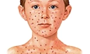 varicela la copii jpeg