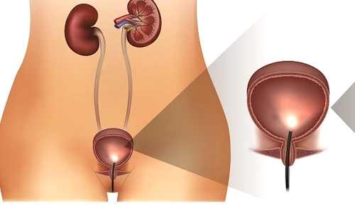 1 ce sa stii despre citoscopie jpg jpeg