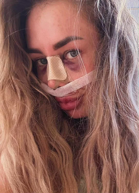 Maria Avram, după operația estetică - Foto: social media 