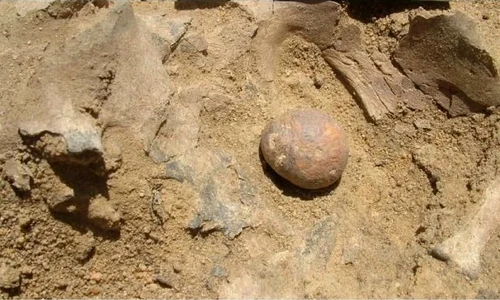 S au descoperit cele mai vechi pietre la prostată jpeg