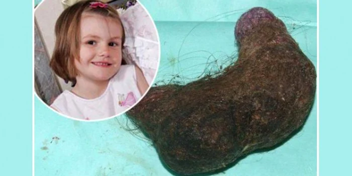 Copila avea in stomac o bilă uriaşă de păr nedigerat