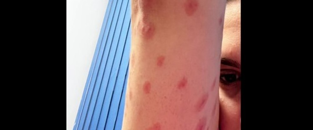 O studentă care stă într-un cămin din Regie a ajuns la medic mușcată de ploșnițe. Cum răspunde Universitatea din București