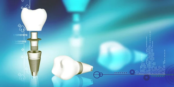 Implant dentar Foto dentaclinic ro