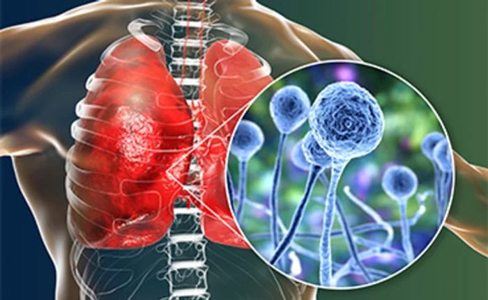 Extrem de periculoasă, “Ciuperca Neagră” aduce și mai multe probleme în plină pandemie de COVID-19