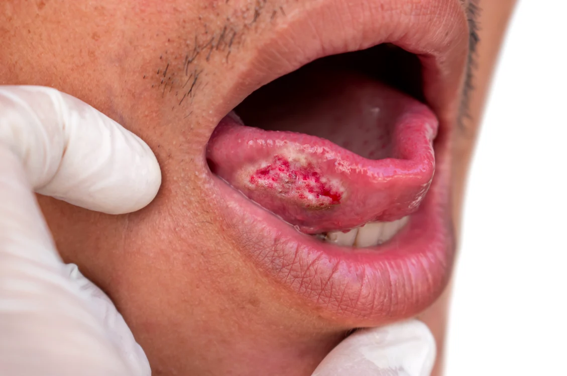Cancerul oral se află pe locul 16 între cele mai frecvente tipuri de cancer. FOTO: Shutterstock