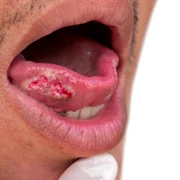 cancerul oral shutterstock 2236521813 jpg
