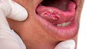 cancerul oral shutterstock 2236521813 jpg