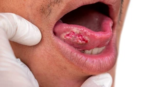 cancerul oral shutterstock 2236521813 jpg
