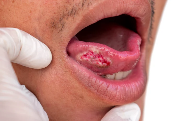 Cancerul oral se află pe locul 16 între cele mai frecvente tipuri de cancer. FOTO: Shutterstock