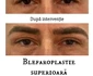 blefaroplastie iancu morad luxury 3 jpg