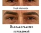 blefaroplastie iancu morad luxury 3 jpg