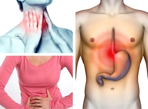 regim reflux gastroesofagian jpg jpeg