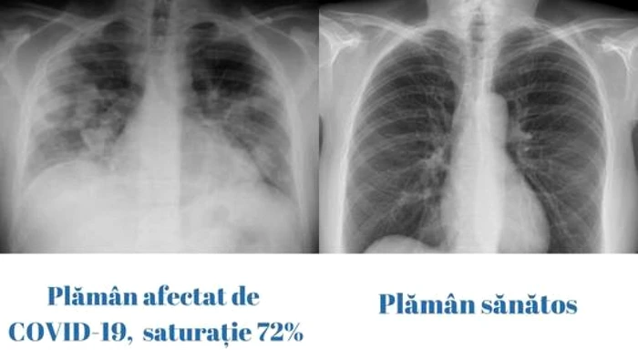 plaman sanatos vs plaman bolnav foto cncav