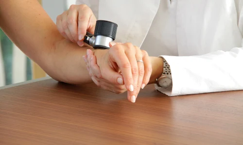 alunita dermatoscop jpeg