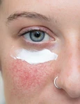 rozacee acid azelaic shutterstock 1498857530 jpg