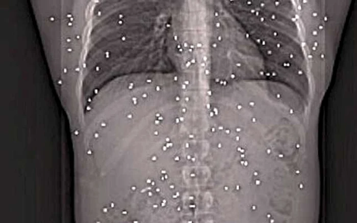 Cum arată resturile de proiectile din trupul bărbatului, la radiografie FOTO: Daily Mail