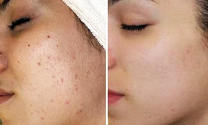8week acne challenge before after article new article new2 article new jpeg