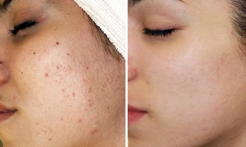 8week acne challenge before after article new article new2 article new jpeg