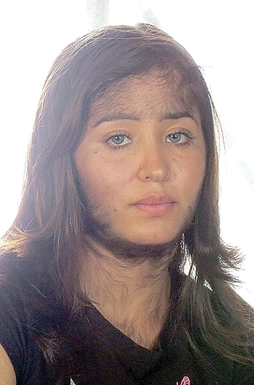 Karla (14 ani) s-a obişnuit  cu blăniţa de pe chip