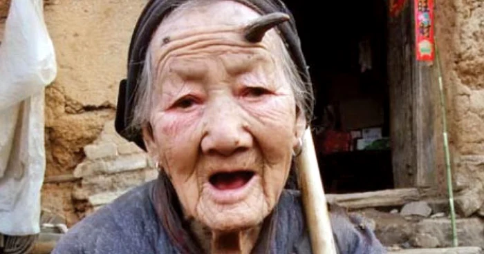 Zhang Ruifang are pe frunte un corn de 6 centimetri