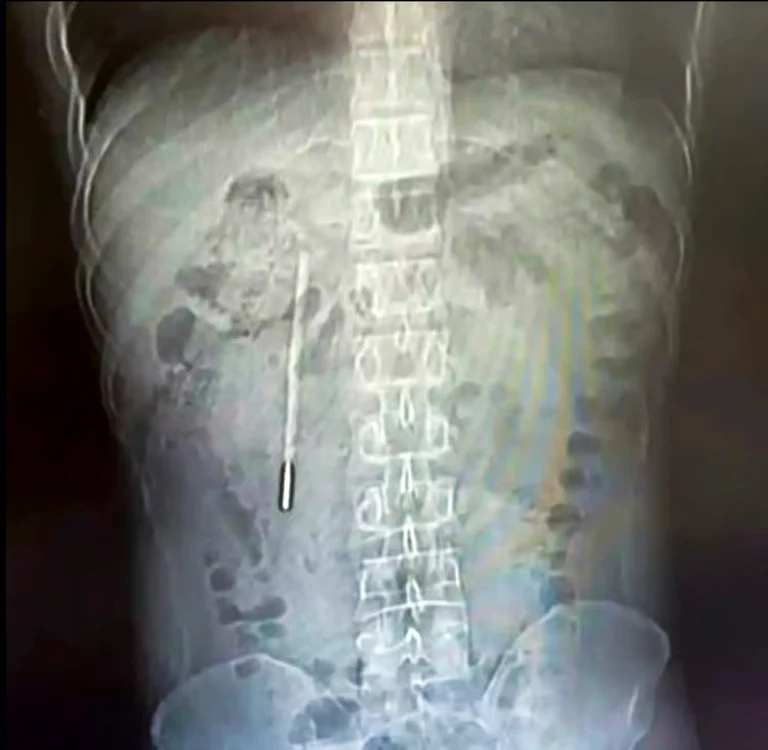 Medicii și-au dat seama imediat despre ce este vorba / foto: Weibo