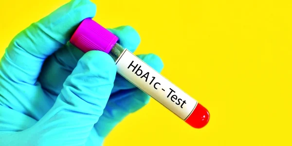 analize de sange test diabet diabet zaharat glicemie investigatii
